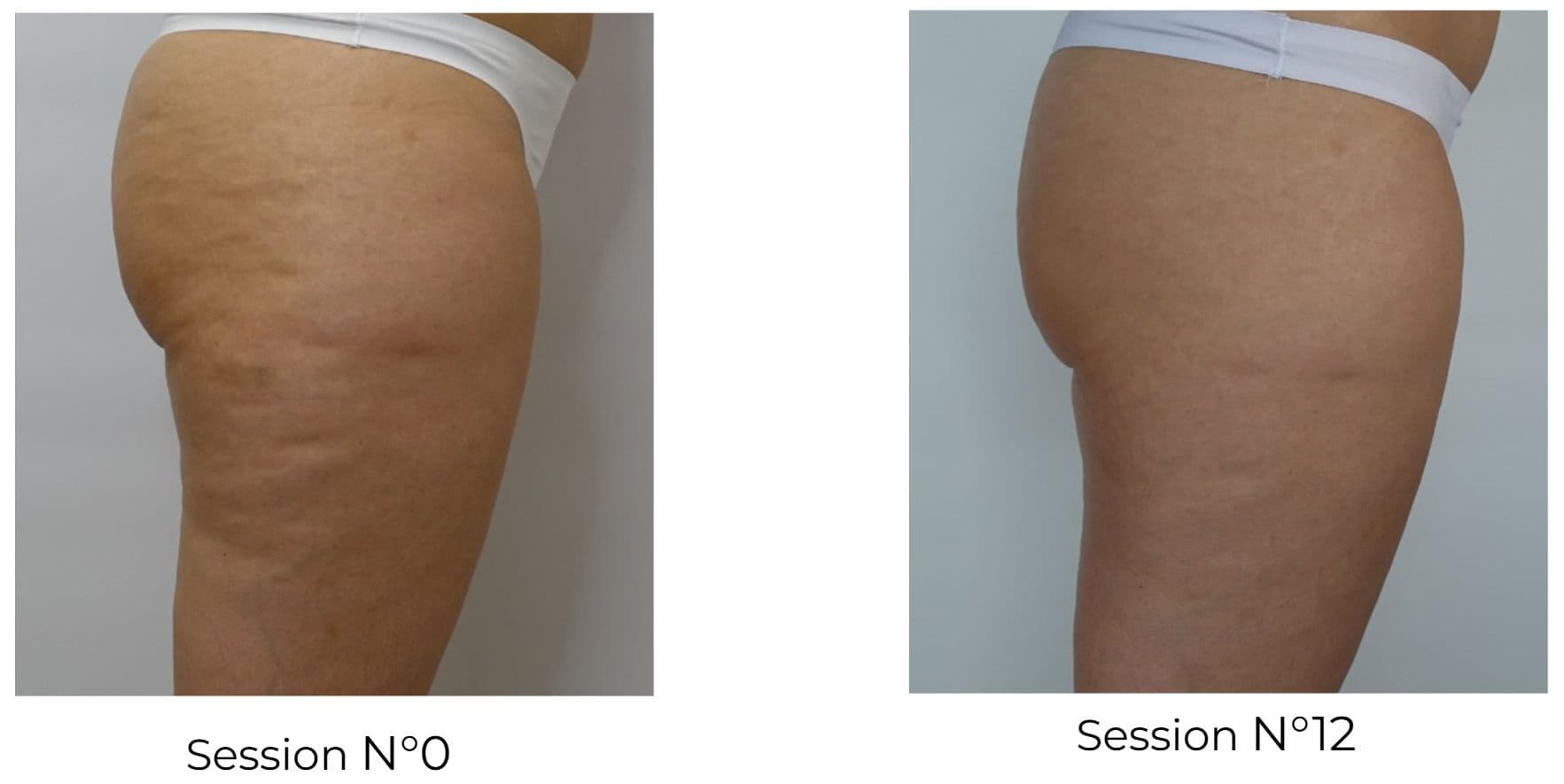 LPG Endermologie – seitliche Ansicht, Session 0 im Vergleich zu Session 12