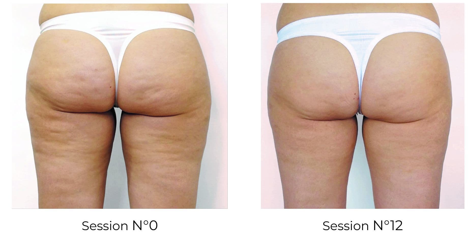 LPG Endermologie – Rückansicht, Session 0 im Vergleich zu Session 12